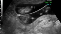 Płód w 12 tygodniu ciąży (bliźniaki)