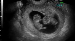 Płód w 8 tygodniu ciąży (bliźniaki)