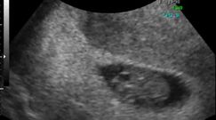 Płód w 9 tygodniu ciąży (bliźniaki)