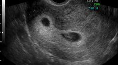 Płód w 9 tygodniu ciąży (bliźniaki jednokosmówkowe)