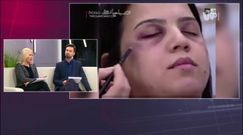 Makijaż, dzięki któremu zatuszujesz siniaki po pobiciu przez męża. Kobiety są oburzone