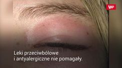 Plaster pod oczy wywołał alergię