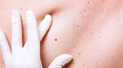 Objawy raka, które widać na skórze