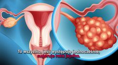 Jeden z najczęściej ignorowanych objawów raka jajnika 