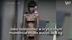 Nastolatka ważyła niecałe 17 kg. Opublikowała przerażające zdjęcia