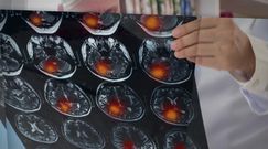 Objawy udaru mózgu u kobiet są inne niż u mężczyzn