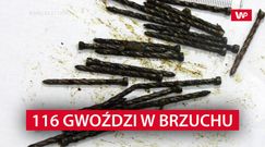 Przyszedł do lekarza z bólem brzucha. Powód był zdumiewający