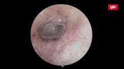 Odczuwał dyskomfort w uchu. Okropne, co laryngolog znalazł w środku