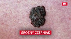 Groźny czerniak. Wyniki nowych badań nie są optymistyczne