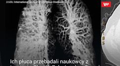 Co koronawirus robi z płucami.  Wstrząsające zdjęcia włoskich lekarzy