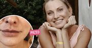 Joanna Moro poprawiła urodę. Pokazała zdjęcia przed i po. Z takiego zabiegu korzystają szlachetnie urodzeni