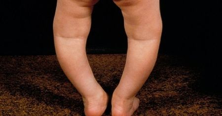 Katowali córkę restrykcyjną dietą. Doprowadzili do poważnej choroby