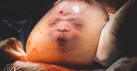 W czepku urodzony. Niezwykle rzadki przypadek