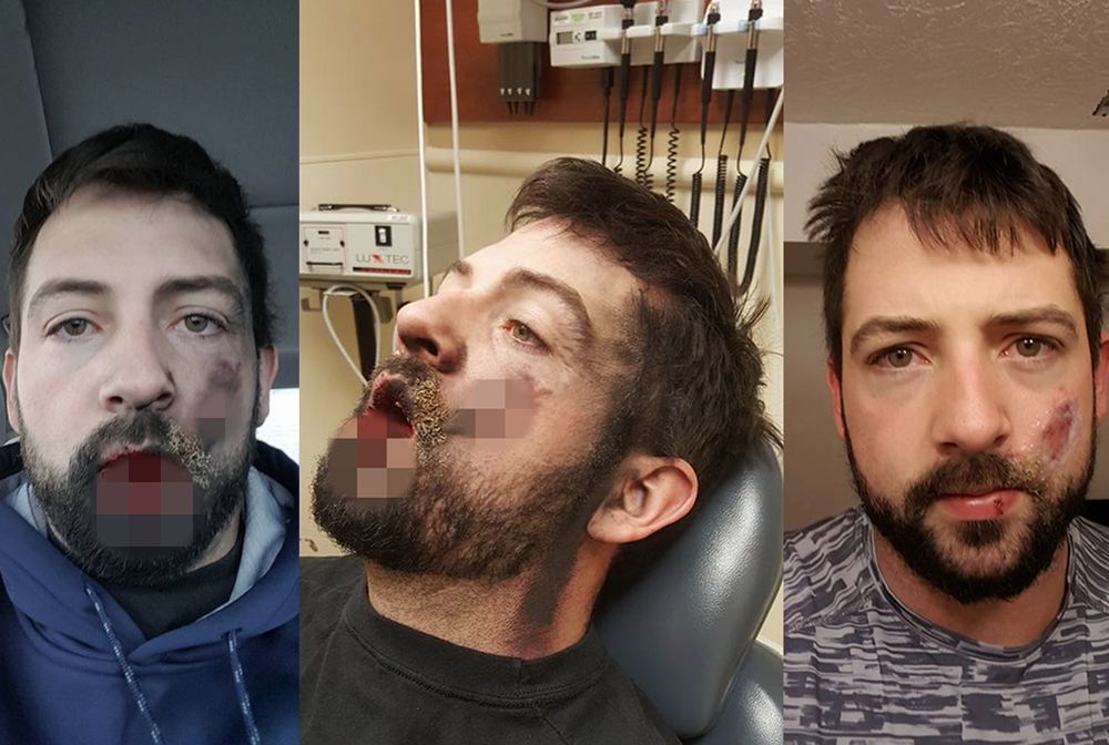 E-papieros eksplodował mu w ustach. Stracił 7 zębów