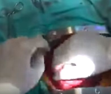 Operowali na otwartym sercu w trakcie trzęsienia ziemi. Mimo silnych wstrząsów, nie zostawili pacjenta