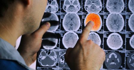 Lek na prostatę hamuje chorobę Parkinsona. Nadzieja dla chorych