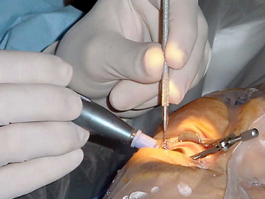 Lekarz przeprowadza zabieg usunięcia katarakty