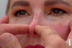 "Plastyczna fuszerka": Chirurg przeraził się, gdy zobaczył jej nos
