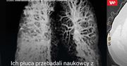 Co koronawirus robi z płucami.  Wstrząsające zdjęcia włoskich lekarzy