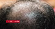 Jest nadzieja dla tych, którzy za szybko stracili włosy
