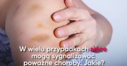 Dolegliwości i choroby, które objawiają się siniakami