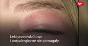 Plaster pod oczy wywołał alergię