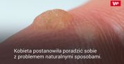 Kobieta przyłożyła do skóry plaster z rozgniecionym czosnkiem. Zobacz, co się stało