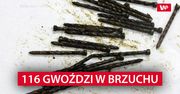 Przyszedł do lekarza z bólem brzucha. Powód był zdumiewający