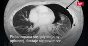 O jedną igłę za daleko. 79-latka musiała przejść bolesny zabieg
