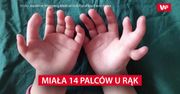 14 palców u rąk. Lekarze musieli wybierać