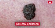 Groźny czerniak. Wyniki nowych badań nie są optymistyczne