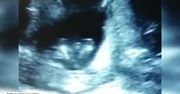 Nienarodzone dziecko klaszcze na USG