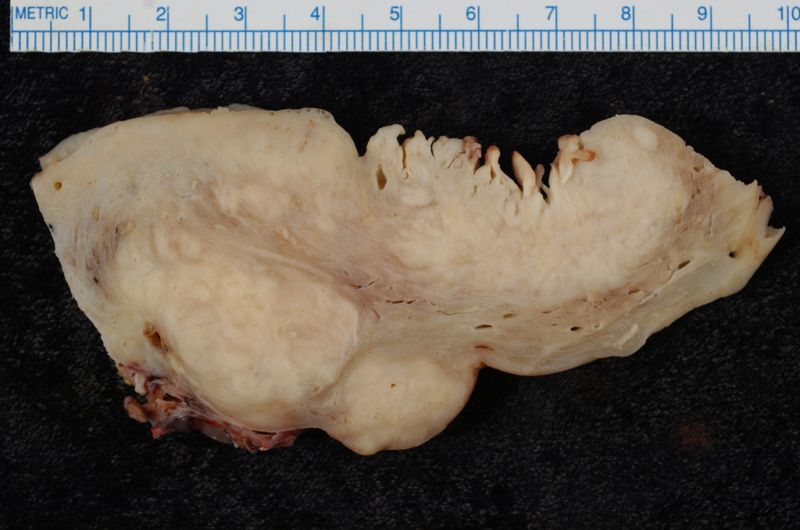 Zdjęcie gruczolaka endometrium 