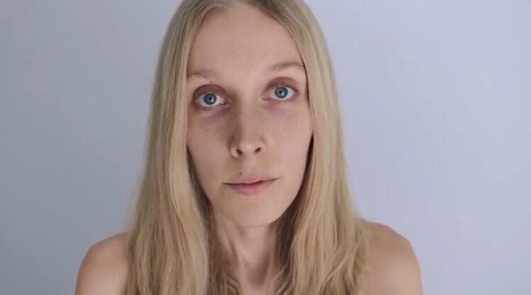 Agnieszka przeżyła 22 dni bez jedzenia. Pokazuje, jak wygląda jej ciało