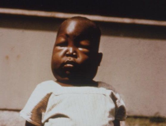 Dziecko z malarią 