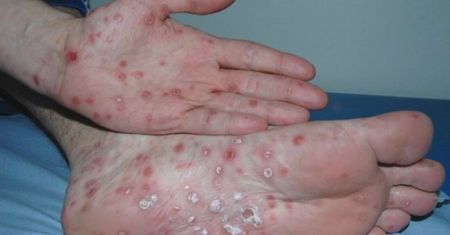 Zapomniana choroba wróciła do Europy. Dawniej zabijała wszystkich