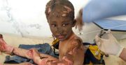 Wojna w Syrii: Drastyczne zdjęcia dzieci rannych po użyciu bomb zapalających