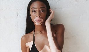 Niezwykła modelka skąpana w słońcu. Winnie Harlow prezentuje się obłędnie