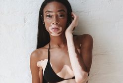 Niezwykła modelka skąpana w słońcu. Winnie Harlow prezentuje się obłędnie