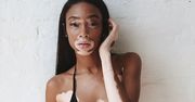 Niezwykła modelka skąpana w słońcu. Winnie Harlow prezentuje się obłędnie