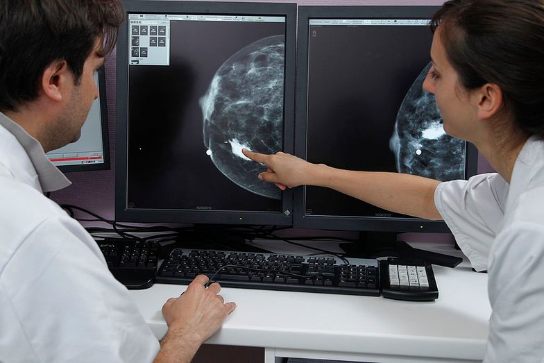 Sztuczna inteligencja wykrywa raka piersi lepiej niż lekarze