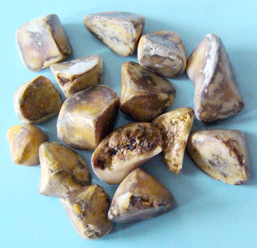 Kamienie powstałe w czasie kamicy żółciowej 