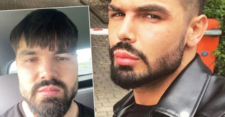 Zniekształcili twarz Pawła z „Love Island”, ale to jeszcze nie wszystko. Celebryta opublikował zdjęcie oszpeconej łydki. „Byłem królikiem doświadczalnym”