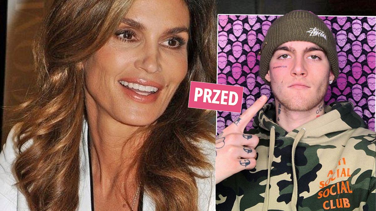 Spore zmiany na twarzy 21-letniego syna Cindy Crawford. Bolesny zabieg dał nieprawdopodobny efekt