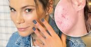 Maja Bohosiewicz pod grubą warstwą makijażu ukrywała trądzik. Teraz pokazała, jak naprawdę wyglądała jej twarz