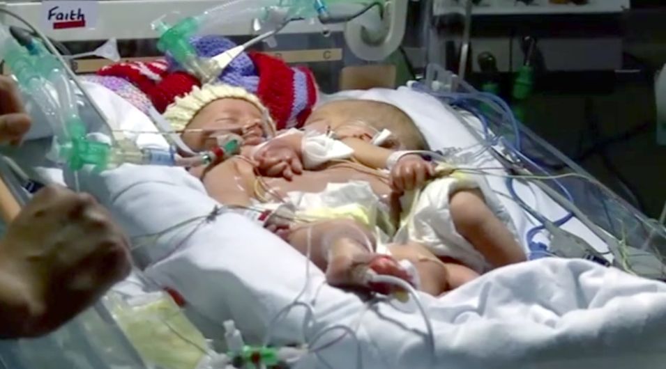 Laura Williams jest najmłodszą Brytyjką, która urodziła zrośnięte bliźnięta 