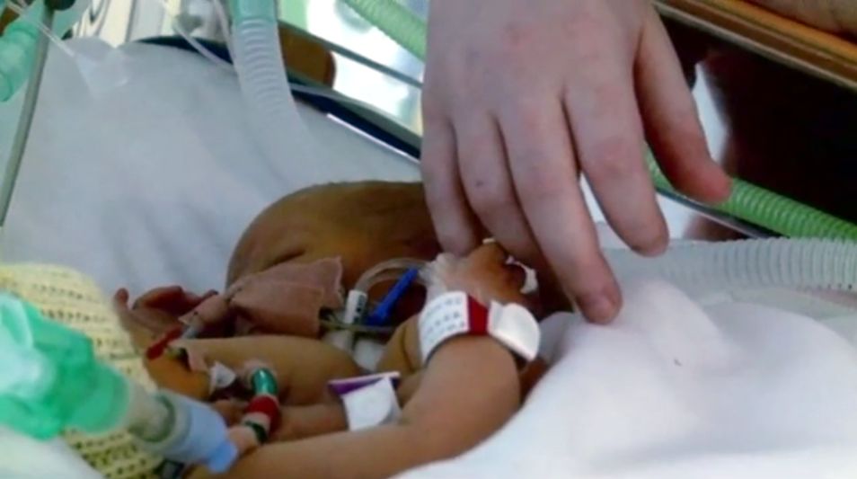 Laura Williams jest najmłodszą Brytyjką, która urodziła zrośnięte bliźnięta 