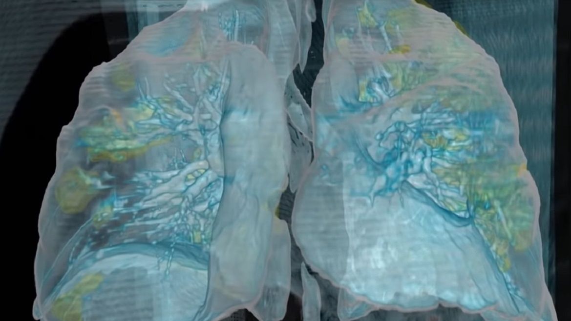 Co się dzieje z płucami osób zarażonych koronawirusem?