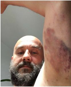 "Oto efekt konfrontacji ze Strażą Marszałkowską". Protestujący z Sejmu publikują zdjęcia swoich ran