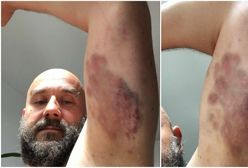 "Oto efekt konfrontacji ze Strażą Marszałkowską". Protestujący z Sejmu publikują zdjęcia swoich ran